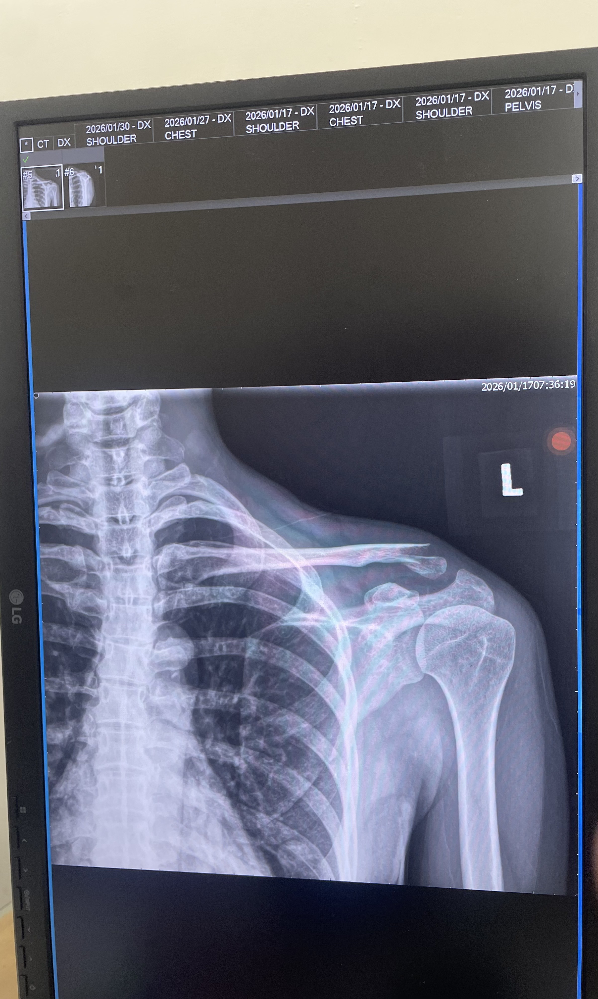 鎖骨骨折X光-術前