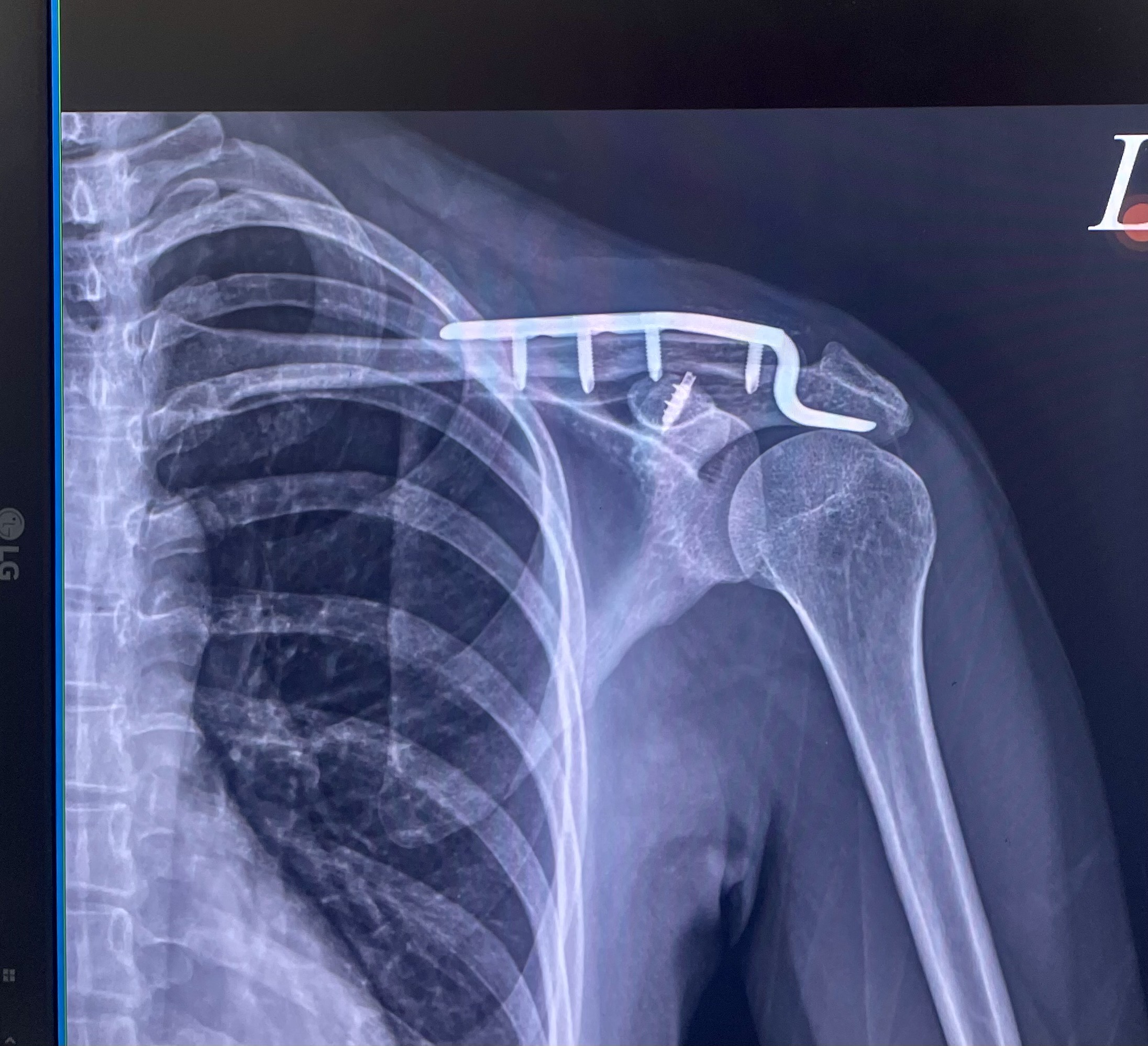 鎖骨鈦骨板X光-術後